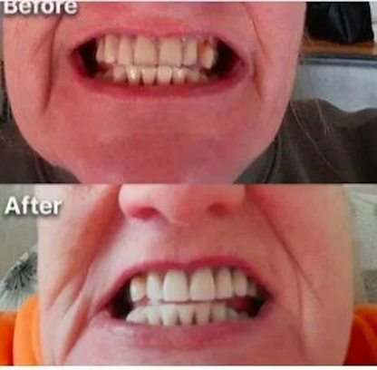 Purple Whitening Strips -7-Day Shocking Transformation Kit